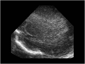 Sagittal periventricular hyperechoic areas and beginning cavitation