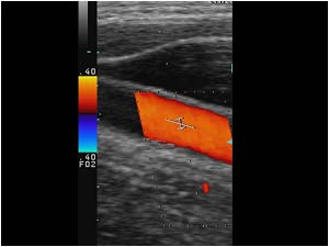 Normal doppler signals in the common carotid artery and internal and external carotid artery