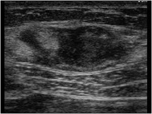 Endometriosis in the abdominal wall