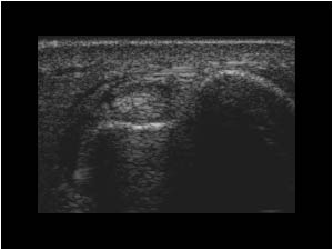 Tenosynovitis of the extensor carpi ulnaris tendon transverse