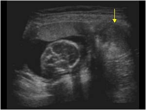 Dermoid cyst / cystic teratoma and pregnancy