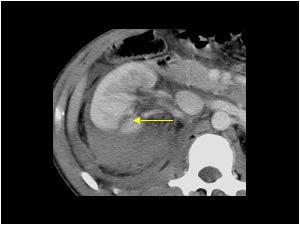 Laceration of the lowerpole of the right kidney