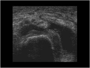 Effusion and synovial thickening in the talonavicular joint transverse