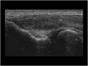Thickened inhomogeneous tendon radial collateral ligament longitudinal