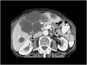 Multiple liver cysts before hemorrhage