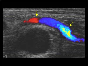 Ganglion cyst with compression of the tibial artery longitudinal