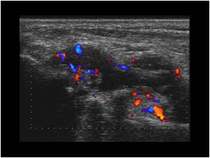 Synovial thickening with hypervascularity and effusion of the carpal joints