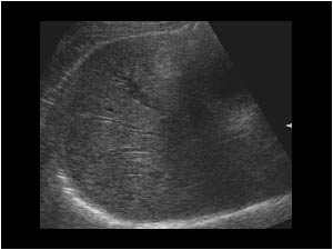 Hemobilia with slight dilatation of the bile ducts and echoic structures in the common bile duct but a normal gallbladder
