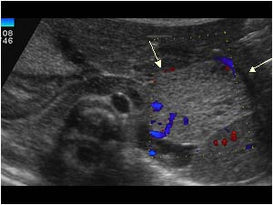 Extrapulmonary sequestration with a vascularized microcystic mass in the left upper abdomen transverse
