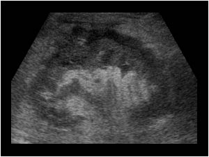 Enlarged left kidney and an infiltrating mass in the perirenal tissues longitudinal