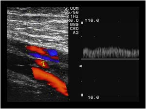 Thrombus filled superficial femoral vein with flow in the small central lumen longitudinal