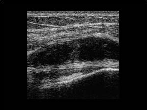Hemorrhagic effusion along the biceps tendon longitudinal