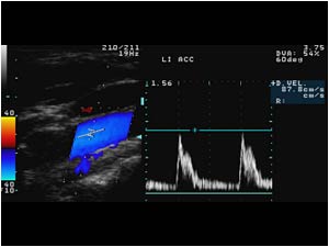 Normal doppler signal in the left common carotid artery