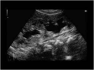 Dilatation of the urinary tract on the left side