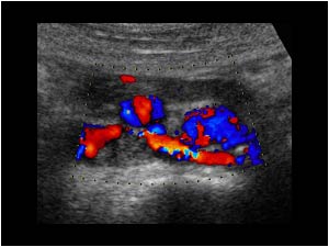 Thrombus in the vena cava and and flow from the left renal vein along the thrombus transverse