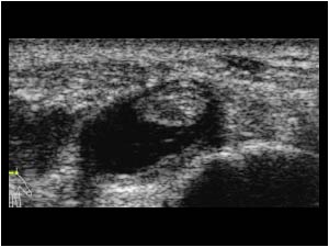 Effusion in the tendon sheath of compartment 3 transverse