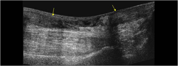 Full thickness achilles tendon rupture with retraction of the tendon ends longitudinal