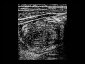 Thickened appendix that mimics an intussusception transverse