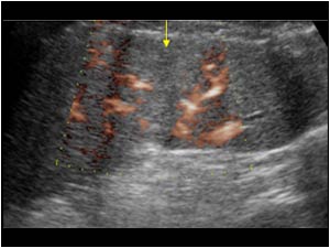 Splenic rupture with hypovascularity