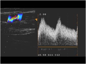 Stenosis in the cephalic vein with high systolic velocity