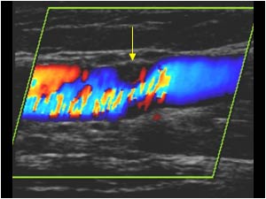 Stenosis in the cephalic vein with high systolic velocity