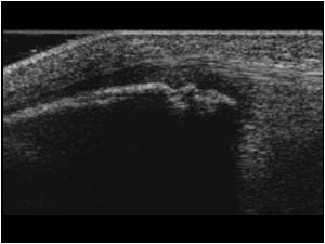 Cartilage swelling and bony fragmentation of the lowerpole of the patella longitudinal