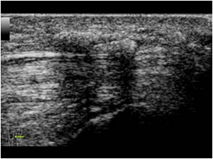 Soft tissue calcifications anterior of the left quadriceps tendon transverse