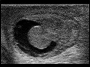 Thickened epididymis and hydrocele on the left side
