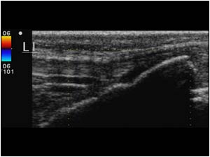 Normal side no neovascularity