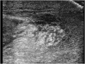Thickened edematous scrotal wall