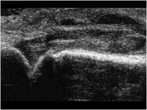 Synovial mass and extensor tendon longitudinal