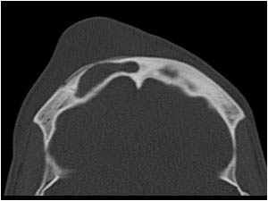 Case of the month April 2006: Other sites of inflammation