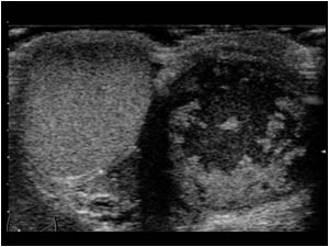 Normal testicle and epididymitis on the right side with caseous changes