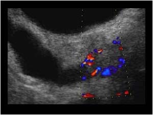 Vascularized mass in the pancreatic head