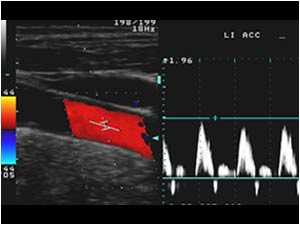 High resistence doppler signal in the left common carotid artery