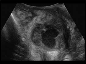 Large intrascrotal abscess