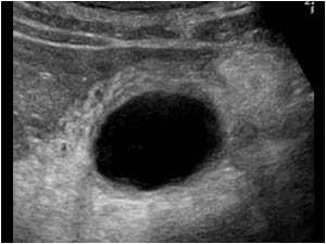 Cholecystitis with a thickened wall