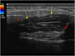 No vascularity in the lesion