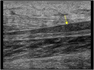 Thickening of the plantaris tendon longitudinal