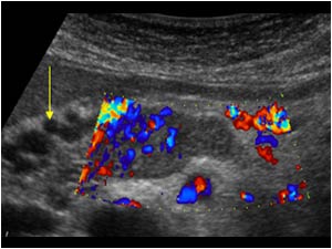 Collateral veins and vascularity in the tumor thrombus