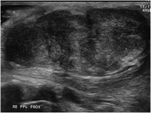 Palmar fibroma anterior of the flexor pollicis longus tendon longitudinal