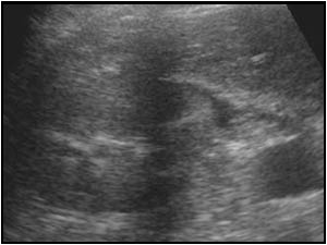 Small perirenal effusion on the right side transverse