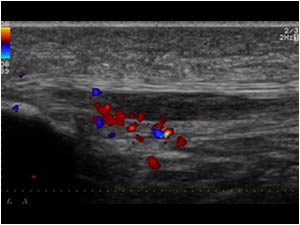 Area of tendinosis on the lateral side longitudinal