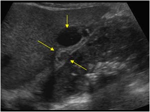 Gallbladder perforation and pericholecystitis longitudinal