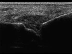 Synovial thickening of the second MTP joint
