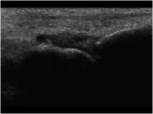 Slight synovial thickening of the third MTP joint