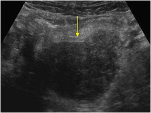 Hemorrhagic necrotic tordated ovarian cyst transverse