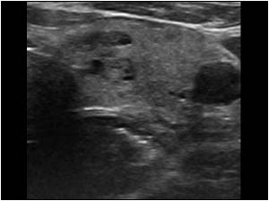 Esophagus carcinoma with a hypoechoic mass dorsal to the thyroid gland transverse