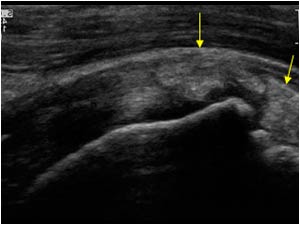 Calcific tendinitis with calcifications penetrating in the bursa