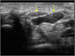Median nerve and anomalous flexor digitorum superficialis muscle of the index finger transverse